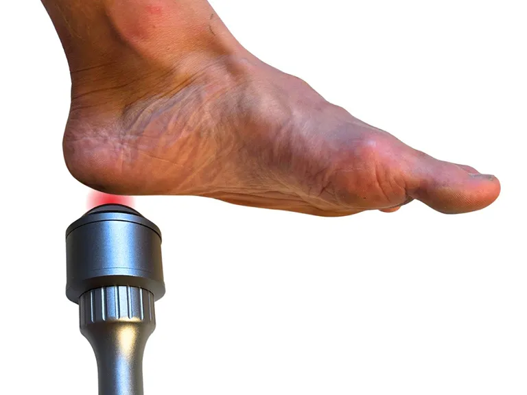 Laser Treatment on Foot